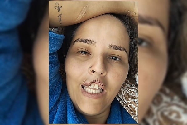Sem avisar, marido manda matar chow-chow que arrancou lábio de mulher