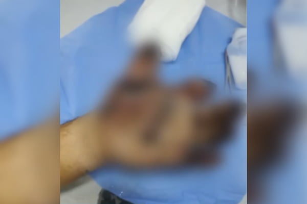 Pintor perde dedos da mão após bomba explodir em casa de ex-PM em SP