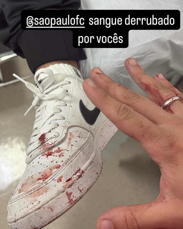 Torcedor atingido por placa do Morumbis fraturou crânio e está na UTI