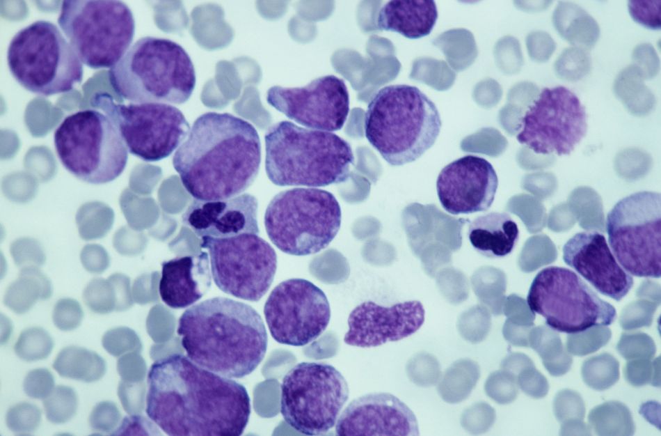 Novo estudo descobre como proteína afeta crescimento de células de câncer