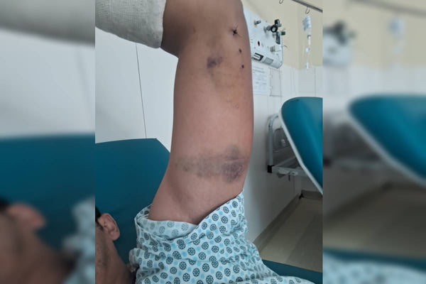 Pintor é atacado por cães em mansão de influencer e ex-De Férias com Ex