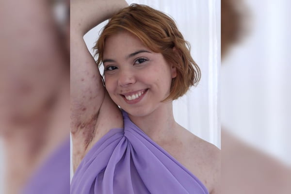 “Tenho fadiga constante”, diz jovem que vive com 3 doenças autoimunes