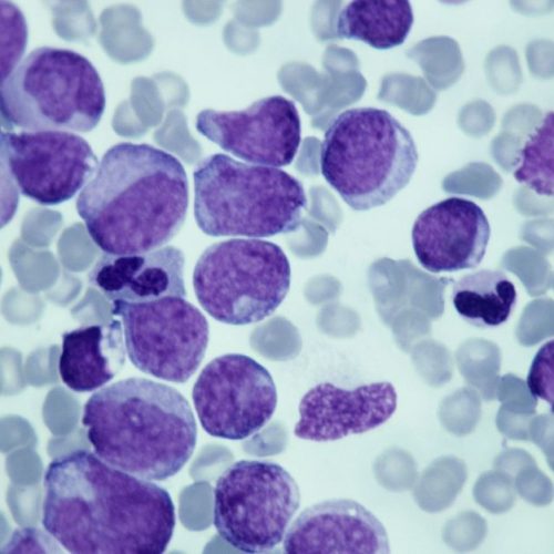 Novo estudo descobre como proteína afeta crescimento de células de câncer