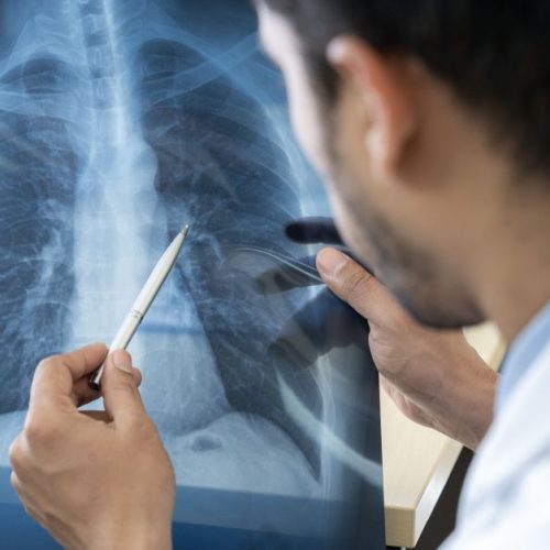 Entenda o que é pneumonia silenciosa, que tem alertado autoridades de saúde